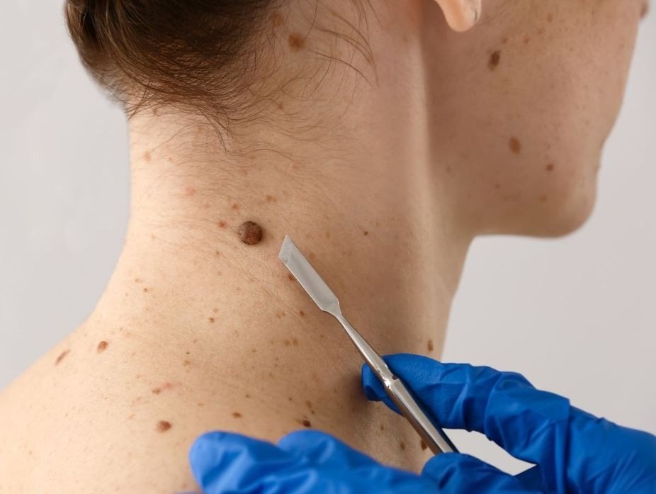 Best Skin Cancer Treatment in Ambala