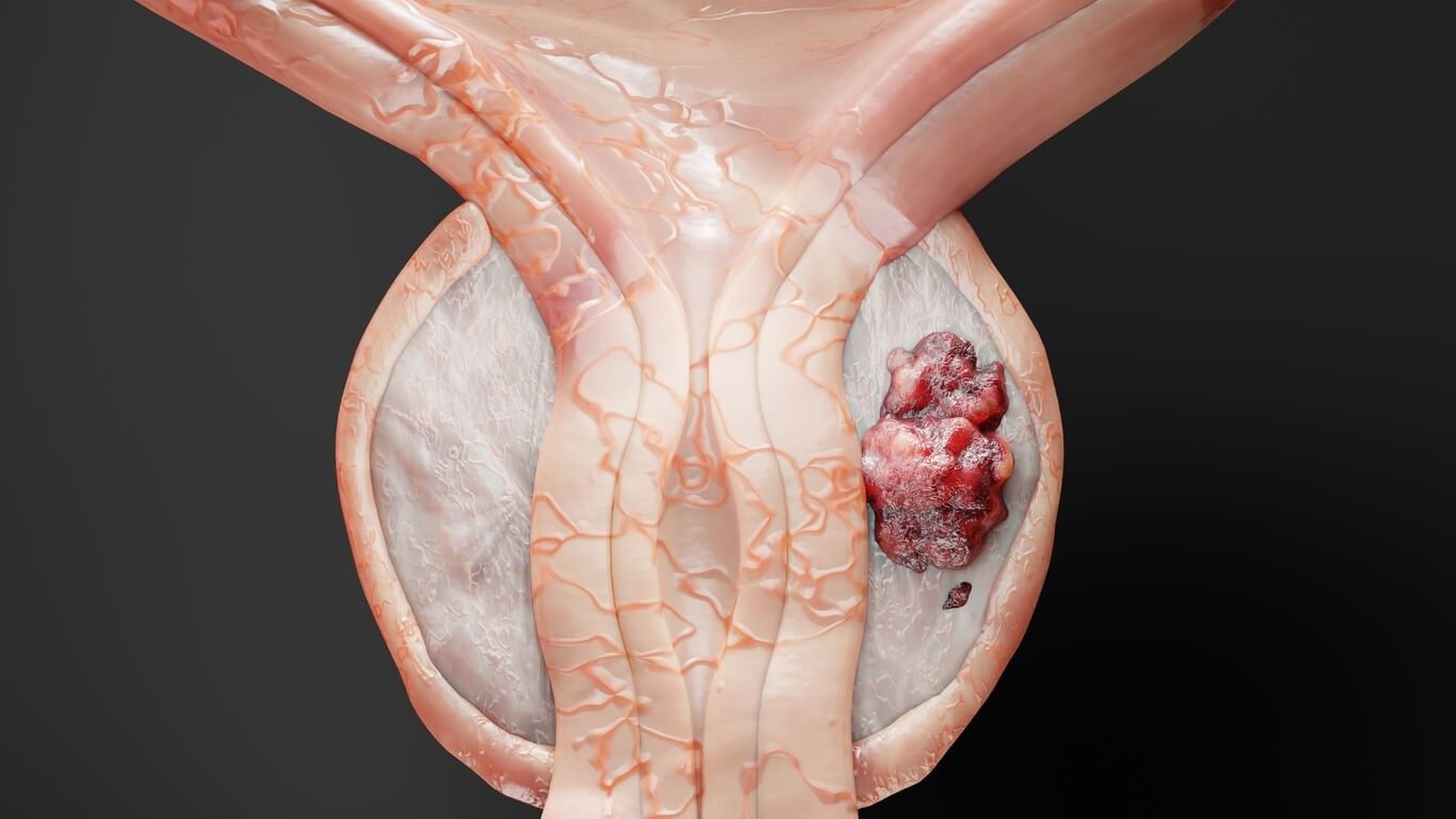 Best Prostate Cancer Specialist in Patiala