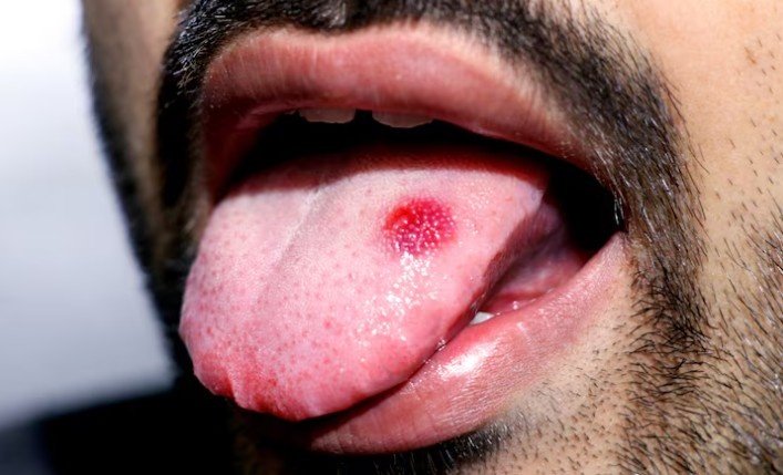 Best Tongue Cancer Specialist in Punjab