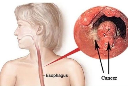 Best Food Pipe Cancer in Patiala