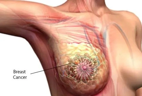 Best Breast Cancer Doctor in Patiala