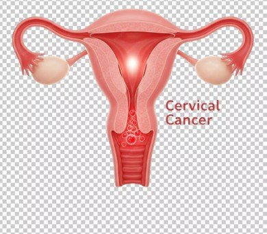 Cervical Cancer Doctor in Punjab
