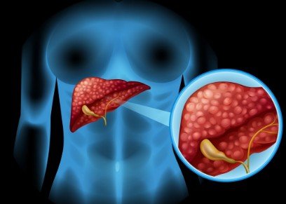 Pancreatic Cancer Specialist in Punjab